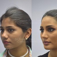 Foto-foto itu diunggah di Instagram oleh Froilan Paez, seorang dokter yang berspesialisasi dalam bedah hidung estetikan dan fungsional. Pada unggahannya itu Froilan memberikan keterangan dengan tagar #rhinoplasty, #mentoplasty, #otoplasty. Foto: Instagram @froilanpaez