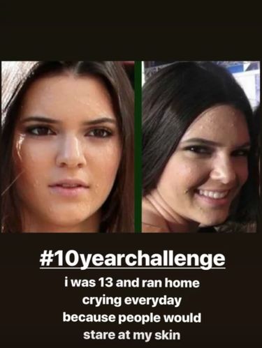 Curhat Kendall Jenner Pernah Jerawatan Parah, Sampai Bikin Dirinya Minder