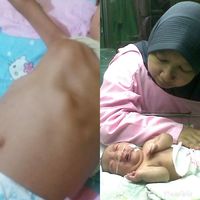 Dada kanzu yang membusung dan kondisi Kanzu saat baru lahir yang membengkak.