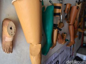 Serba-serbi Kaki Palsu Agar Pasien Amputasi Berjalan Lagi, Yuk Donasi!