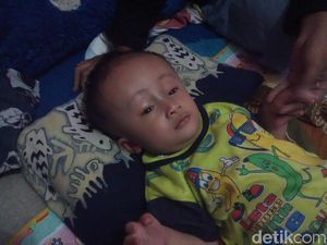 Bayi 8 Bulan di Bandung Barat Ini Kelainan Tempurung Kepalanya
