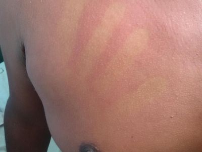 Waspada DBD, Begini Potret Ruam Merah Gejala Khas Penyakit