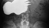 Sendok dan garpu jadi salah satu benda yang paling sering tertelan lewat tenggorokan. Tapi hasil pemeriksaan x-ray yang satu ini tunjukkan belasan sendok dan garpu yang berada di dalam perut manusia. Foto: Istimewa