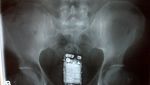 Ponsel hingga Stoples Selai, Ini 10 Benda Aneh yang Ditemukan dalam Tubuh Manusia