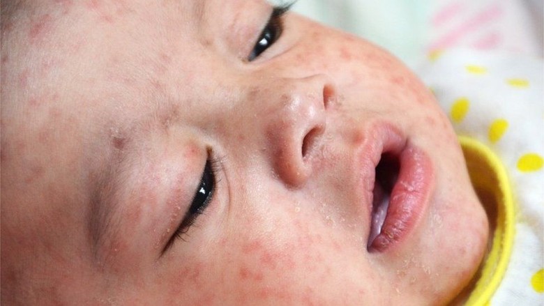 Wabah Campak Landa Manila, 2 Juta Anak yang Belum Divaksin Terancam Wabah Campak Landa Manila, 2 Juta Anak yang Belum Divaksin Terancam