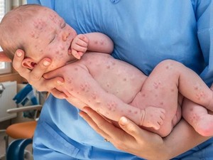 8 Mitos Vaksinasi Pemicu Munculnya Kembali Penyakit yang Bisa Dicegah