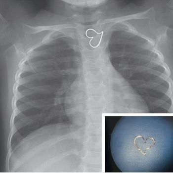 Simbol jantung hati dalam foto rontgen ternyata liontin yang tertelan.