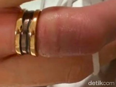 Menggemuk, Cincin Rp 23 Juta Terpaksa Dipotong dari Jari Wanita Ini