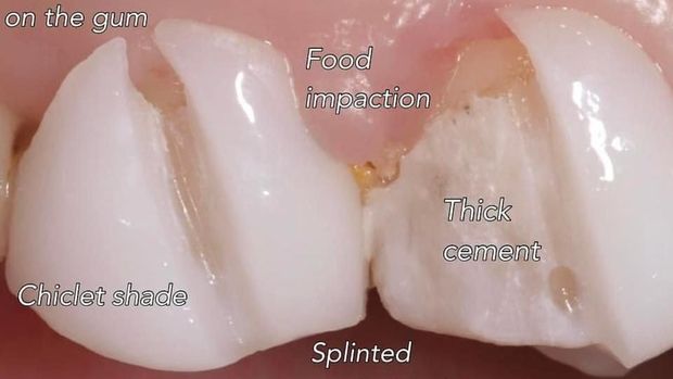 Sisa makanan menempel di veneer gigi yang tersambung. (Foto: Instagram/drgastridk/korbantukanggigi)