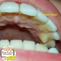 Veneer gigi yang gagal terpasang.