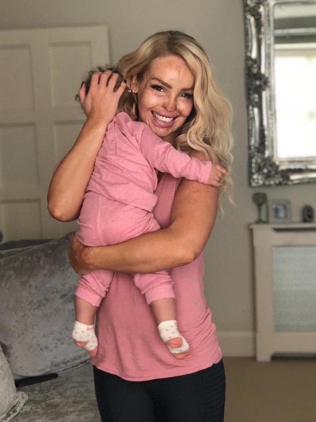 Kini ibu dua anak itu sudah bisa menerima dengan kejadian pahitnya itu di masa lalu. Tapi saat pencangkokan kulit pertama kali dia sempat berpikir untuk bunuh diri. Foto: dok. Instagram (@@katiepiper_)