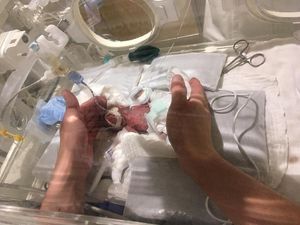Bayi Terkecil di Dunia Lahir di Jepang, Bobot Cuma 268 Gram