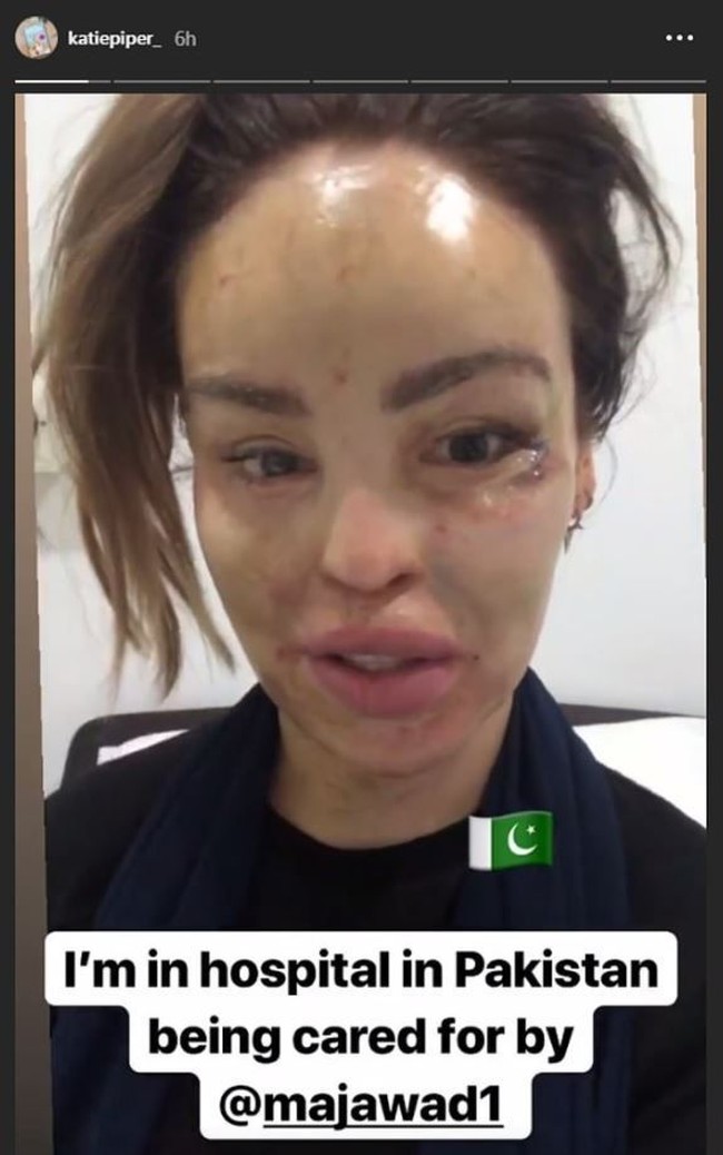 Baru-baru ini, wanita 35 tahun itu kembali melakukan operasi plastik di Pakistan. Ia masih menjalani tahap penyembuhan pascaoperasi.  Foto: dok. Instagram (@katiepiper_)