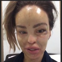 Baru-baru ini, wanita 35 tahun itu kembali melakukan operasi plastik di Pakistan. Ia masih menjalani tahap penyembuhan pascaoperasi.  Foto: dok. Instagram (@katiepiper_)