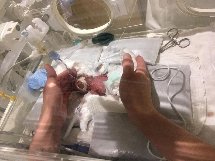 Penampakan Bayi Terkecil di Dunia, Bobotnya Hanya 268 Gram