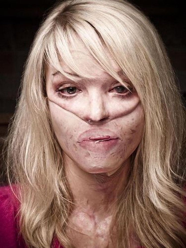 Sebagian hidung dan telinga Katie pun mengalami luka bakar dan yang tersisa hanyalah kelopak mata. Pada tahap awal pemulihan, ia harus menjalani cangkok kulit yang cukup luas di seluruh bagian wajahnya.  Foto: Istimewa