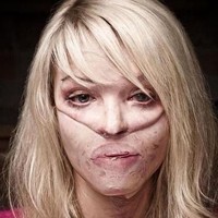 Sebagian hidung dan telinga Katie pun mengalami luka bakar dan yang tersisa hanyalah kelopak mata. Pada tahap awal pemulihan, ia harus menjalani cangkok kulit yang cukup luas di seluruh bagian wajahnya.  Foto: Istimewa