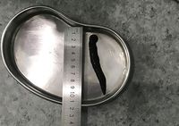 Hii..! Minum Air Mentah, Lintah Panjang Nyangkut di Tenggorokan Pria Ini