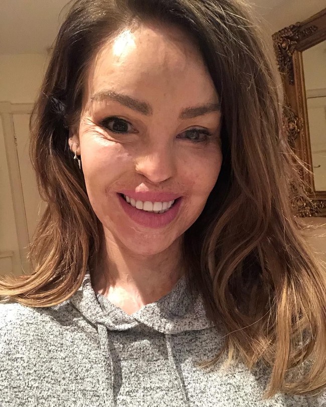Meski sudah menjalani berbagai operasi plastik, wajah Katie tetap tidak seperti sedia kala. Meski begitu ia tetap tampil percaya diri. Foto: dok. Instagram (@@katiepiper_)
