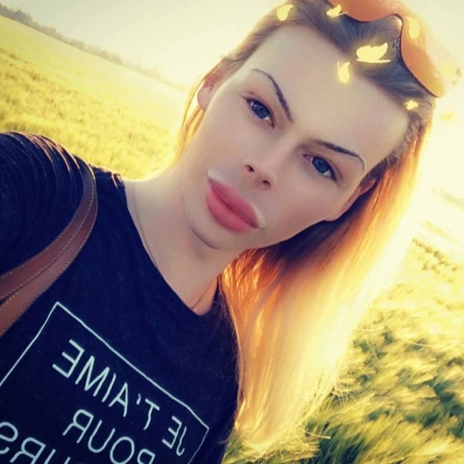 Inilah penampilan Patrick setelah melakukan prosedur kecantikan botox dan filler berkali-kali selama enam tahun ke belakang ini. Penampilan pria 24 tahun itu jadi terlihat seram.  Foto: dok. Facebook (Patrick Mast)