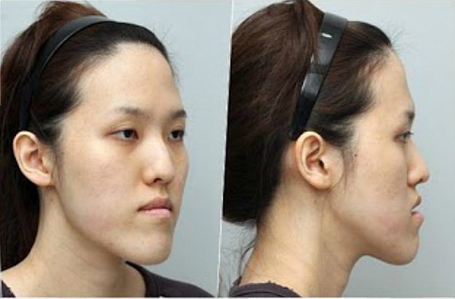 Gadis asal Korea Selatan Shim Yu Ra mengikuti acara realitas Let Me In. Acara ini menghadiahkan mereka dengan makeover penampilan lengkap menggunakan ahli bedah dan prosedur bernilai puluhan ribu dolar. Foto: dok. Koreaboo