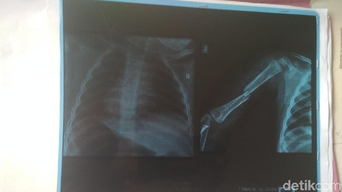 Aksi Biadab Asep, Pelintir Tangan Bayinya Sendiri hingga Patah