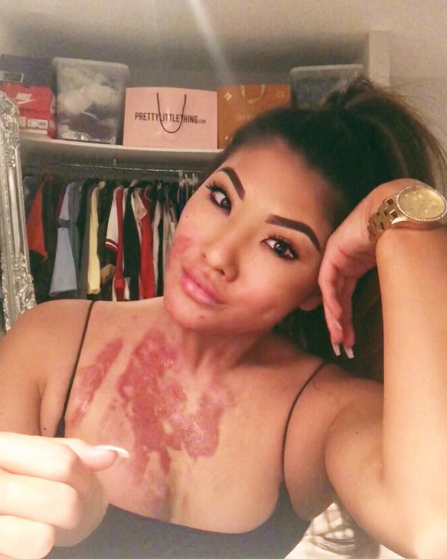 Sophie Lee adalah mantan penari api yang punya kisah miris. Profesinya yang berisiko tersebut membuat Sophie kini hidup dengan luka bakar permanen di area rahang, dagu, leher sampai dada.  Foto: Instagram @sophirelee