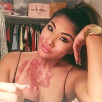 Sophie Lee adalah mantan penari api yang punya kisah miris. Profesinya yang berisiko tersebut membuat Sophie kini hidup dengan luka bakar permanen di area rahang, dagu, leher sampai dada.  Foto: Instagram @sophirelee