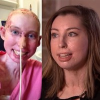 Dokter memperkirakan harapan hidup wanita asal Wrexham, Wales, tersebut hanya 1 : 1000. Namun keajaiban terjadi. Catrin bertahan hidup hingga kini usianya 25 tahun, dan menjadi orang dewasa pertama di dunia yang selamat dari luka bakar parah, meskipun sempat koma selama tiga bulan. Foto: Instagram/@catrinpugh