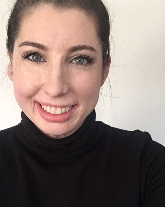 Entah kamu memiliki bekas luka, tanda lahir atau bahkan noda, jangan biarkan jadi penghalang untuk melakukan apapun yang kamu mau, pungkasnya. Foto: Instagram/@catrinpugh