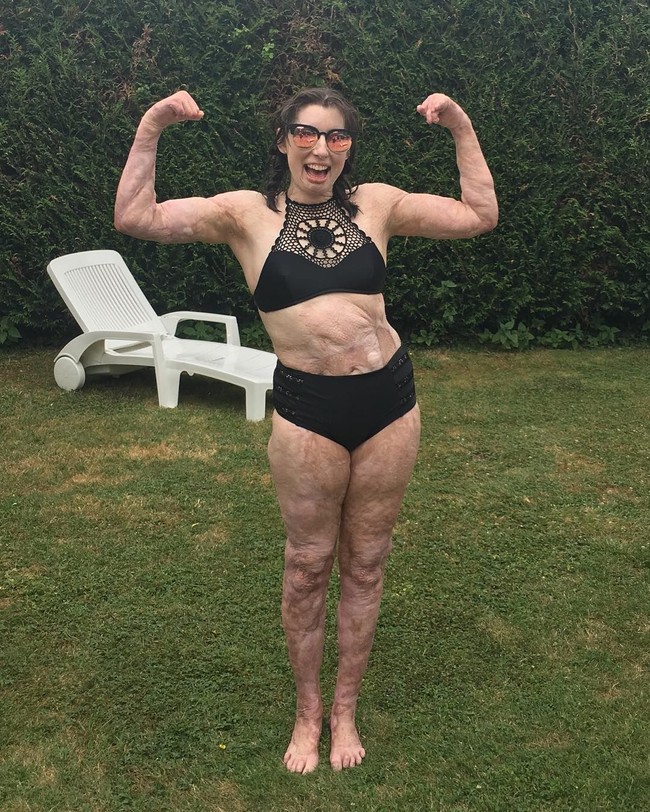 Perlu lebih dari 200 kali operasi untuk memperbaiki jaringan kulit Catrin yang rusak. Ia juga mendapatkan donor kulit dari ibu dan adiknya. Foto: Instagram/@catrinpugh