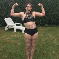 Perlu lebih dari 200 kali operasi untuk memperbaiki jaringan kulit Catrin yang rusak. Ia juga mendapatkan donor kulit dari ibu dan adiknya. Foto: Instagram/@catrinpugh