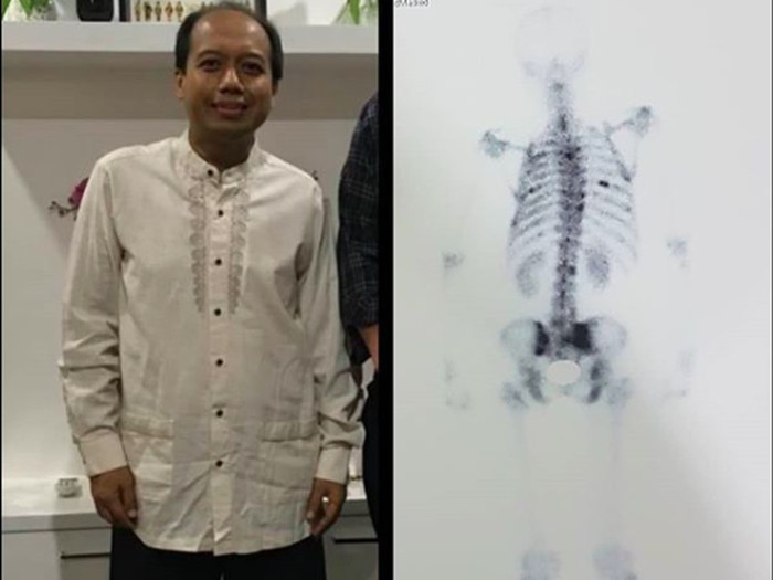 Tulang belakang mulai terkena skoliosis (Foto: instagram Sutopo PN) Tulang belakang mulai terkena skoliosis (Foto: instagram Sutopo PN)