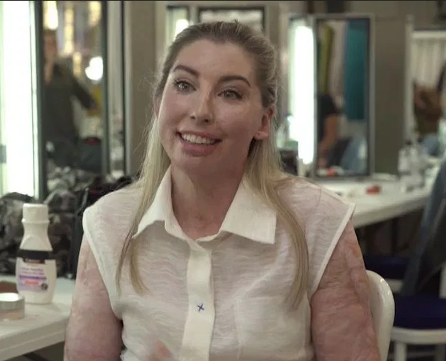 Mengalami lukar bakar di sekujur tubuh, Catrin dengan berani menunjukkan bekas lukanya ke mata publik lewat talkshow Loose Women yang disiarkan di stasiun TV lokal. Ia juga aktif dalam gerakan Body Stories Campaign yang mendorong orang-orang dengan bekas luka, tanda lahir dan stretch marks agar lebih percaya diri. Foto: istimewa