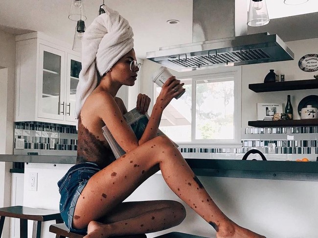 Wanita 25 tahun itu tak ingin terus-menerus hidup dalam ketakutan karena terpengaruh dengan ejekan yang ia terima. Kini Yulianna bangkit dari keterpurukannya dan membawa misi untuk memperkenalkan tanda lahir yang bisa dialami oleh siapa saja.  Foto: Instagram (@yulianna.yussef)