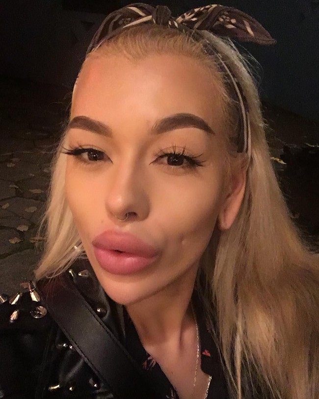 Kegilaannya dengan operasi plastik sudah dimulai sejak lima tahun lalu. Prosedur kecantikan yang pertama kali ia lakukan adalah filler bibir. Yang semakin lama, bibirnya dibuat semakin besar dan tebal.  Foto: Instagram (@elena_rosso)