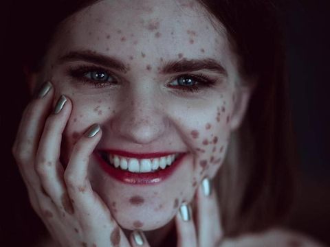 Dibully Seperti Macan Tutul, Wanita Ini Punya Tanda Lahir di Sekujur Tubuh