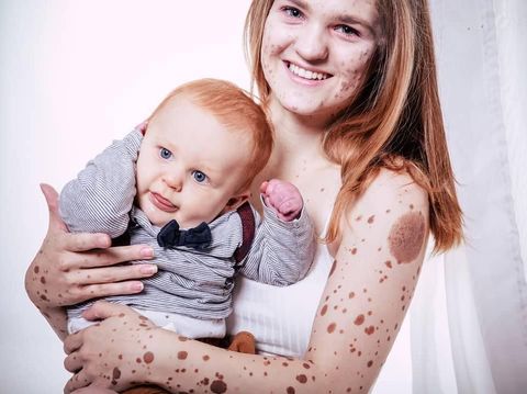 Dibully Seperti Macan Tutul, Wanita Ini Punya Tanda Lahir di Sekujur Tubuh