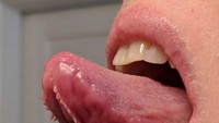 Apa yang tampak seperti akar menggantung di bagian lidah ini sebetulnya adalah lipatan membran yang biasa ada di bawah lidah. Pada beberapa orang membran di bawah lidahnya bisa tampak besar, kondisi yang disebut plica fimbriata.(Foto: SligPants/Wikimedia Commons)