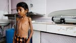 Potret Memilukan Kondisi Anak-anak Korban Perang di Yaman