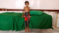 Tak hanya Afaf, Fatima Ibrahim Hadi yang berusia 12 tahun juga mengalami kondisi yang sama. Fatima hanya memiliki berat 10 kg saat difoto di sebuah klinik di Aslam, Hajjah, Yaman. REUTERS/Khaled Abdullah.