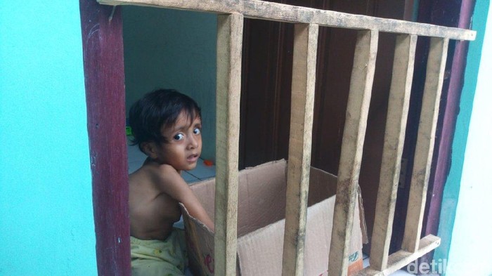 Seorang bocah di Semarang mengidap skoliosis (Foto: Aji Kusuma/detikHealth) Seorang bocah di Semarang mengidap skoliosis (Foto: Aji Kusuma/detikHealth)