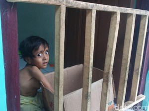 Paru-paru Terhimpit Tulang Bengkok, Bocah 3 Tahun Ini Berjuang untuk Sembuh