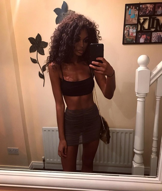 Injeksi tanning ilegal yang dilakukan Hannah tersebut berisiko membuatnya terkena kanker. Namun dia tidak memedulikannya. Aku tidak tahu banyak soal risiko kesehatan dari ini, tapi yang aku rasakan sejauh ini tidak ada hal buruk yang terjadi, ucapnya. Foto: Instagram @dirtyyhippie_