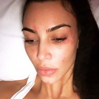 Kim Kardashian sempat membagikan foto wajahnya yang terkena psoriasis kepada puluhan juta follower-nya di Instagram. Wajah tanpa makeup memperlihatkan jelas ruam-ruam merah akibat kondisi kulit yang kabarnya tidak dapat disembuhkan itu. Foto: Instagram