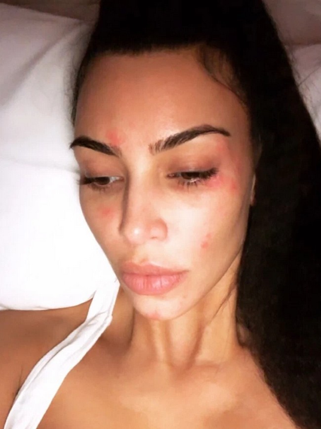 Kim Kardashian sempat membagikan foto wajahnya yang terkena psoriasis kepada puluhan juta follower-nya di Instagram. Wajah tanpa makeup memperlihatkan jelas ruam-ruam merah akibat kondisi kulit yang kabarnya tidak dapat disembuhkan itu. Foto: Instagram