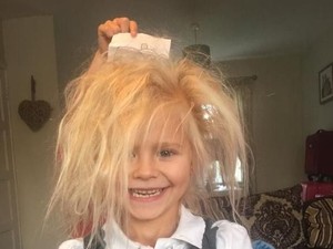 Kena Sindrom Rambut Langka, Gadis Ini Jadi Mirip Chucky dan Boneka Troll