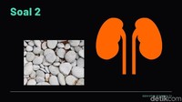 Pembentukan materi keras menyerupai batu yang berasal dari mineral dan garam di dalam salah satu organ vital tubuh. (Foto: detikHealth)