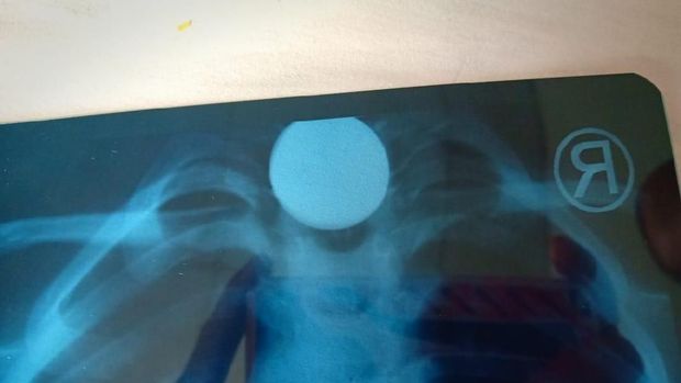 Posisi logam sempat dikhawatirkan menyumbat saluran pencernaan hingga diperkirakan butuh operasi.