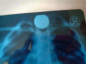 Benda Berbahaya yang Pernah Tertelan Bocah: Koin, Peluit, hingga Sikat Gigi